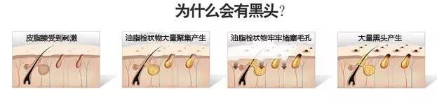 黑头为啥挤了第二天就出来了,黑头挤了两三次会变大嘛