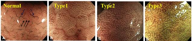 内镜检查痛苦吗,内镜检查是怎么做的