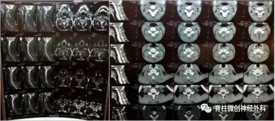 颈椎病嗓子发堵咋回事,喉咙梗阻跟颈椎病有关系吗