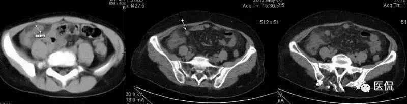 阑尾炎特殊检查讲解视频,阑尾炎病例分析的模板