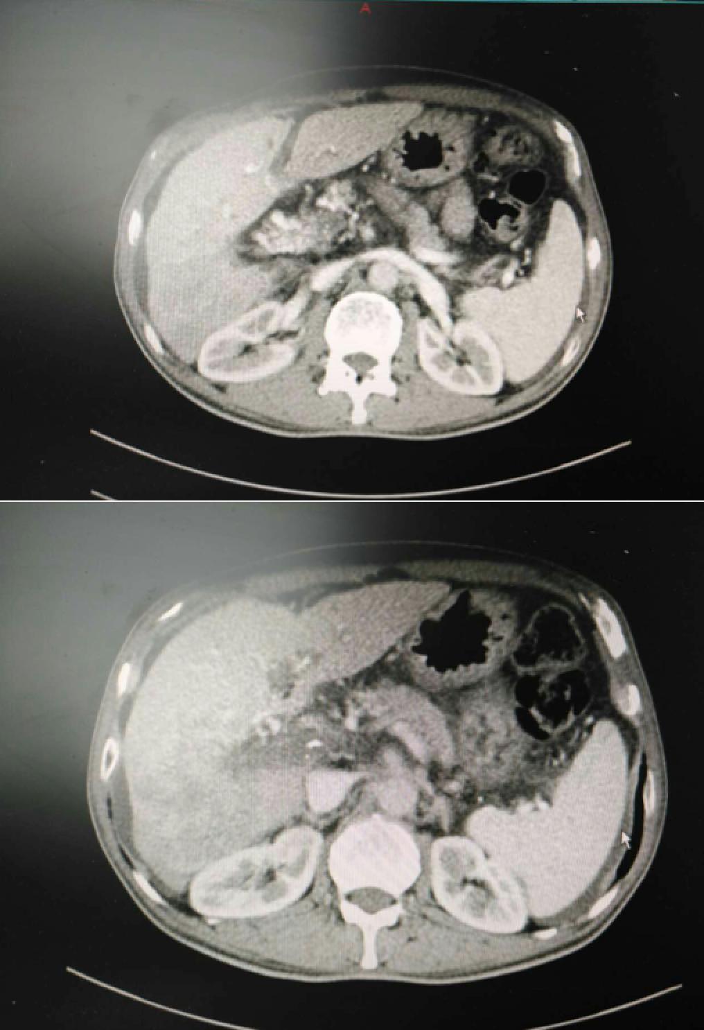 肝癌病例实例100例,肝癌的治疗方法论文