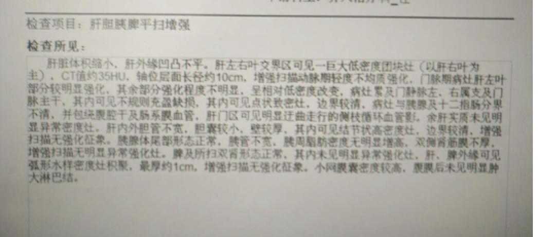 周仲国评价肝癌病例,周仲国分享肝癌早期复发