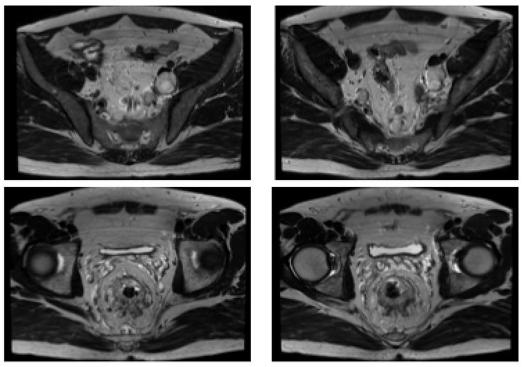 直肠腺癌肺转移最好的治疗方案,得了直肠腺癌不治疗能活几年