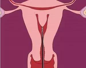 妈妈怀孕时“偷了一下懒”，从此你的子宫多了一坨肉