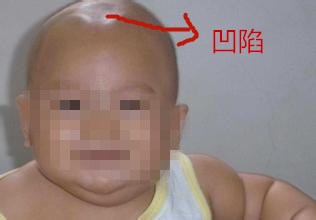 婴儿的囟门小说明什么,婴儿的囟门偏小