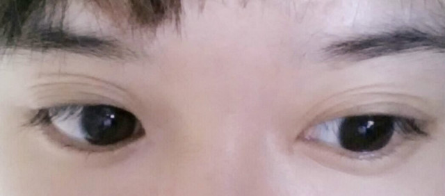 割双眼皮变成三眼皮如何修复,双眼皮修复完变三眼皮