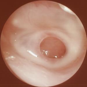 掏耳屎正确掏法,儿童掏耳屎正确方法