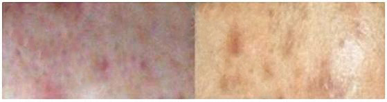 丰唇成香肠嘴视频,丰唇后像鸟嘴