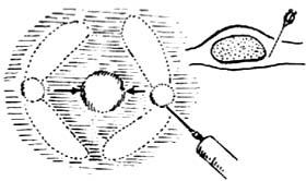 皮脂腺囊肿切除术多少钱,皮脂腺囊肿切除术