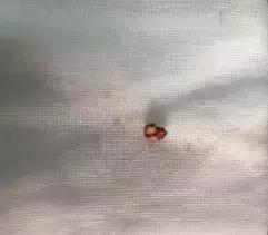 慢性支气管炎会导致咽喉有异物吗,反复咳嗽气管有痰不好怎么办