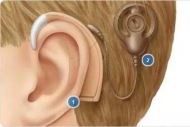周知|为爱转发,泸州、宜宾贫困耳聋患儿可免费植入人工耳窩
