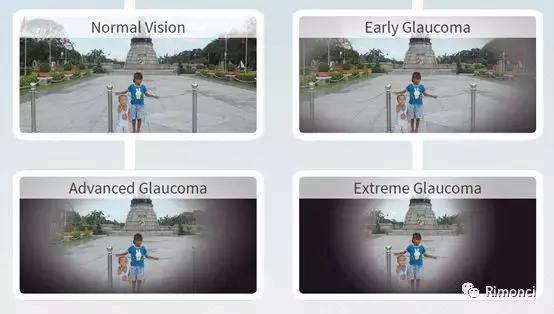 世界青光眼周:我拿什么献给你——我们的青光眼医生!!