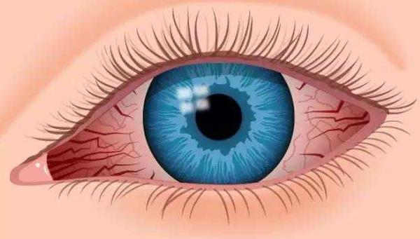 眼睛发痒说是结膜炎反反复复,一觉醒来眼睛又红又痒