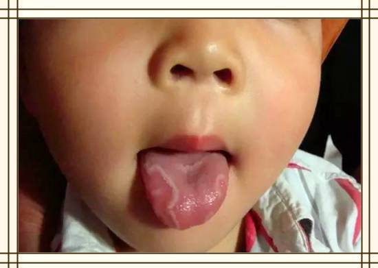 9岁孩子地图舌怎样调理,儿科宋桂华医生