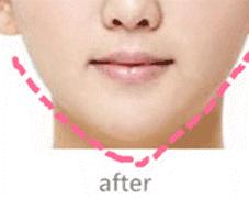 瘦脸针为什么要忌口,瘦脸针禁忌食物