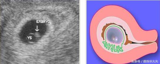 怀孕做阴道B超，会引起流产吗？