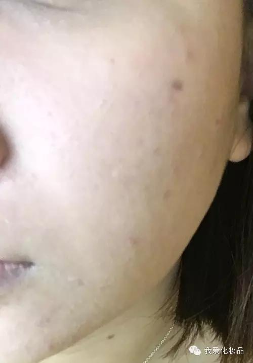 油皮痘肌适合的护肤品牌子,混油皮痘肌适用的护肤品推荐