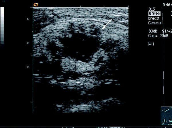 乳腺癌的超声图像表现,早期乳腺癌的超声表现