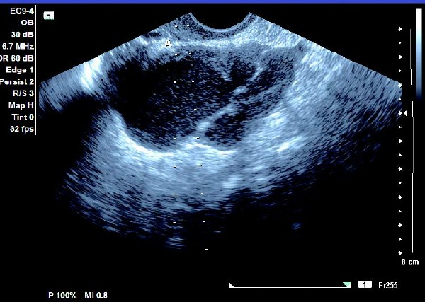 卵巢巧克力囊肿的分型不正确的,怎么辨别是不是卵巢巧克力囊肿