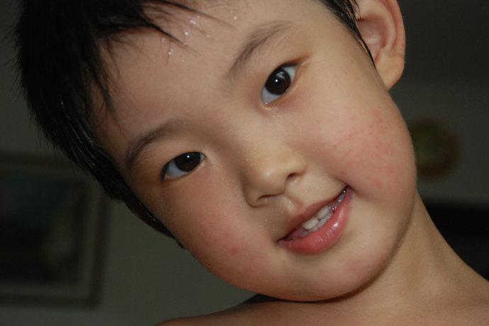 婀跨柟鐥掍絾娌℃湁灏忔按娉℃槸涓嶆槸婀跨柟,婀跨柟鐥掑悧濠村効浼氬洜涓烘箍鐤瑰摥闂瑰悧