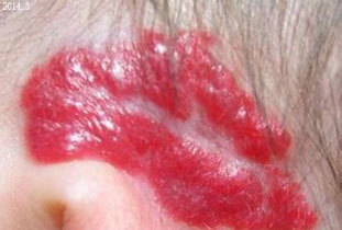 天使之吻红斑消退,天使之吻胎记怎么治疗