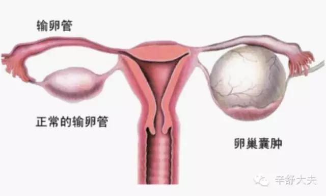 卵巢囊肿需要治疗吗严重吗,卵巢囊肿绝经后会消除吗