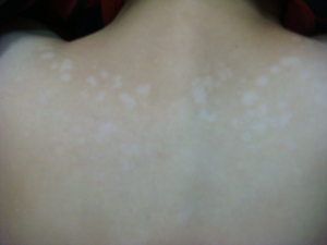 妙治汗斑的实用配方