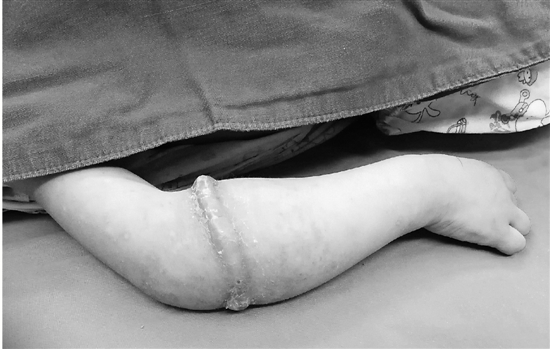 女童手臂环,4岁女童手臂取出肉环