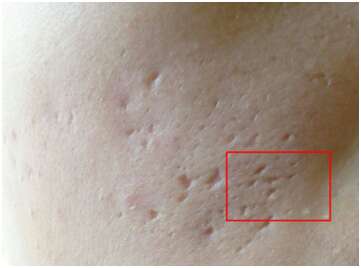 痘痘没了留下痘印怎么解决,痘痘没了留下的红斑怎么办