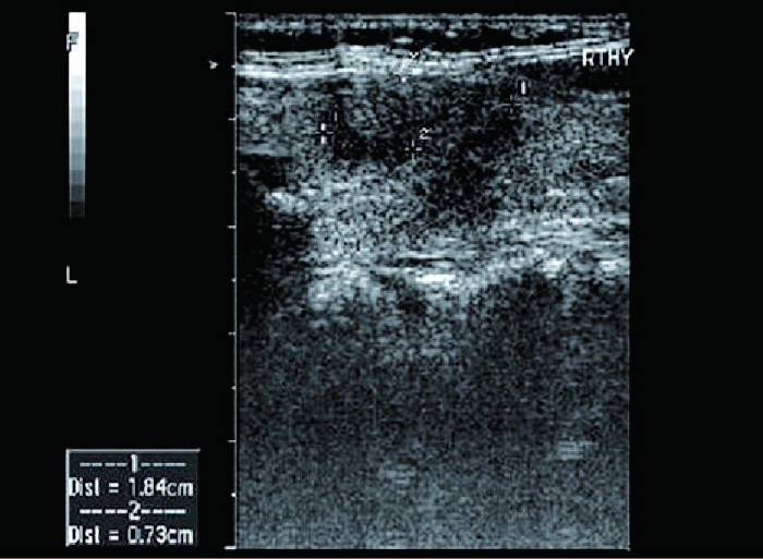 桥本氏甲状腺炎与亚急性甲状腺炎,亚急性甲状腺炎b超下的影像显示