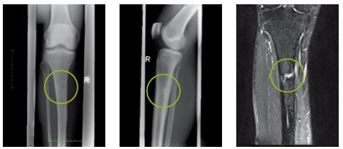 为什么跑步小腿酸痛怎么治疗,跑步哪些行为会造成小腿肌肉疼痛