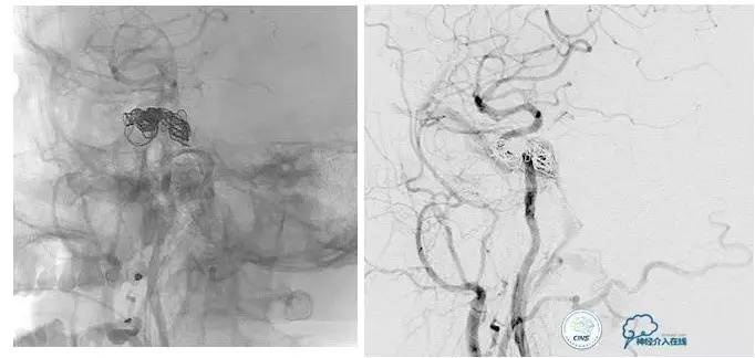 球囊辅助Onyx栓塞治疗硬脑膜动静脉瘘（DAVF）