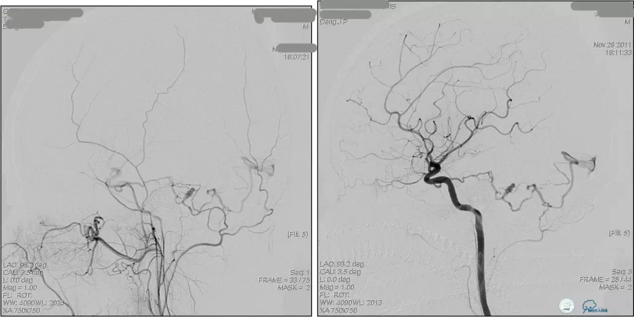 球囊辅助Onyx栓塞治疗硬脑膜动静脉瘘（DAVF）