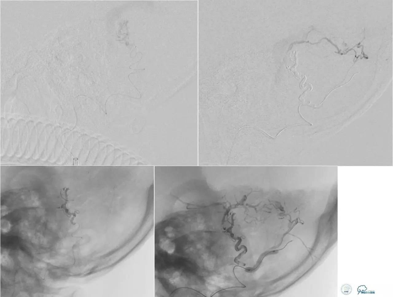 球囊辅助Onyx栓塞治疗硬脑膜动静脉瘘（DAVF）