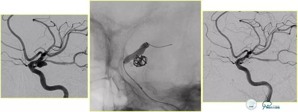 球囊辅助Onyx栓塞治疗硬脑膜动静脉瘘（DAVF）
