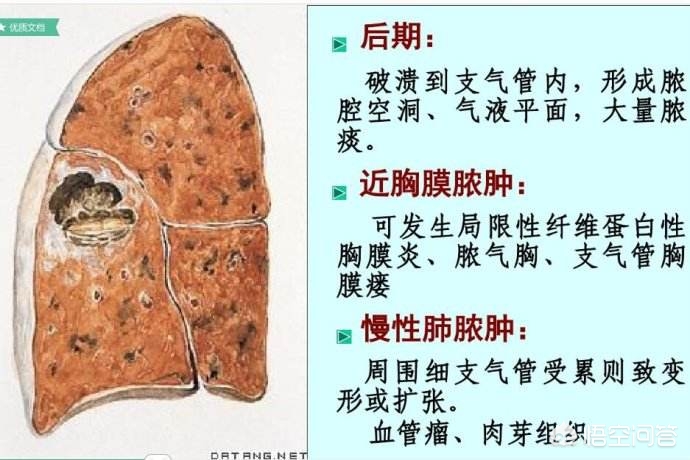 肺上有个洞吐出来的痰又臭又黑,轻微肺堵塞能咳出痰很浓的痰