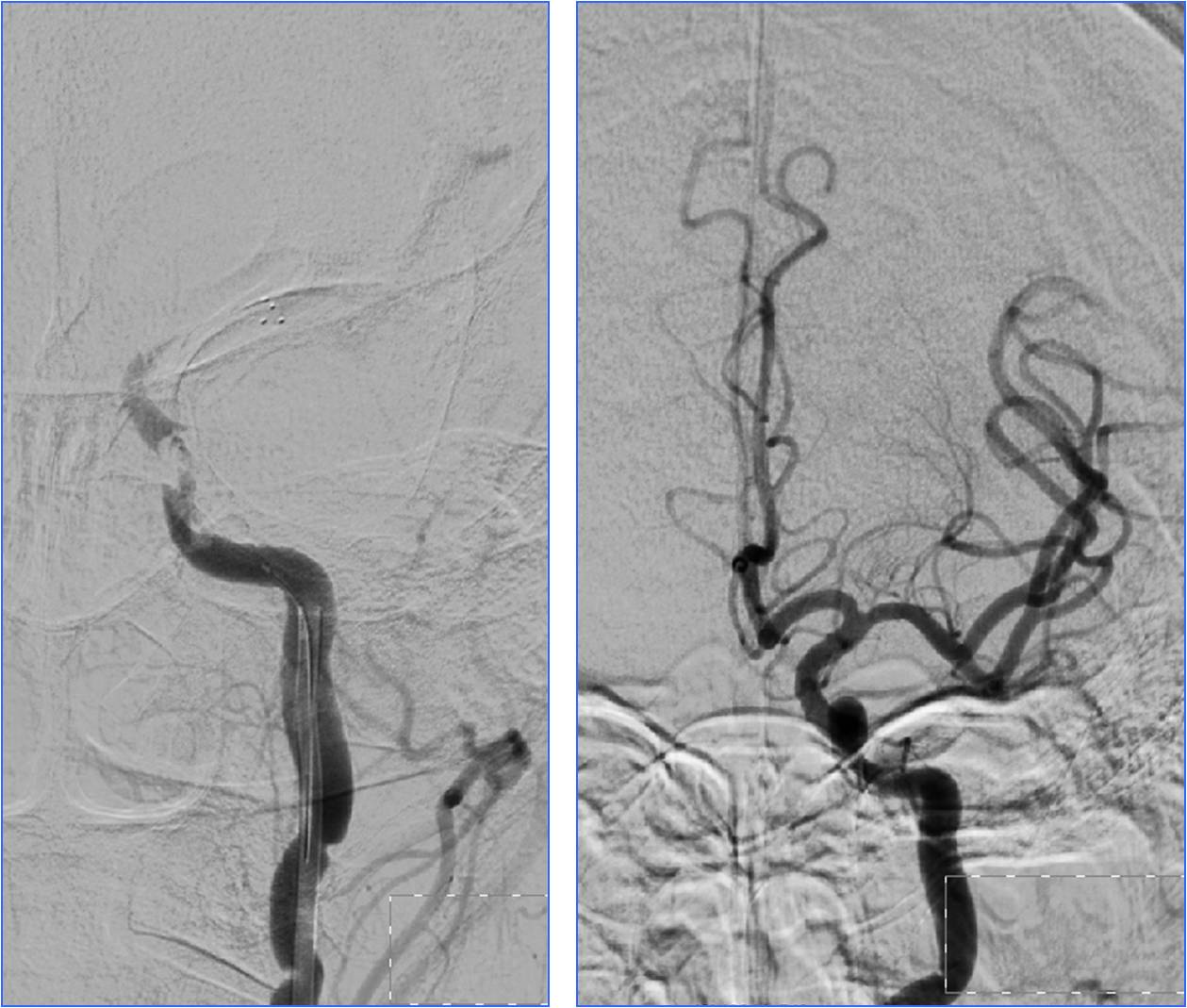 缺血性脑卒中术后管理,急性缺血性脑卒中血管内治疗