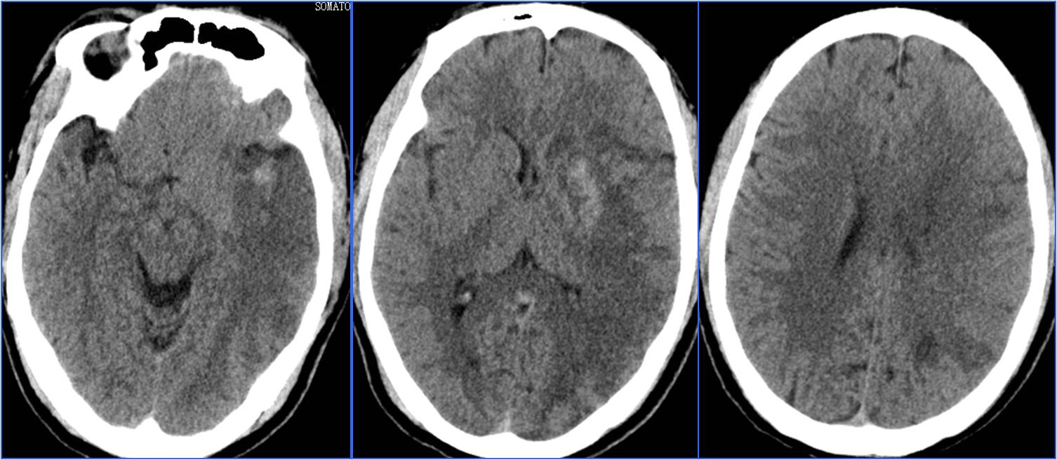 缺血性脑卒中术后管理,急性缺血性脑卒中血管内治疗