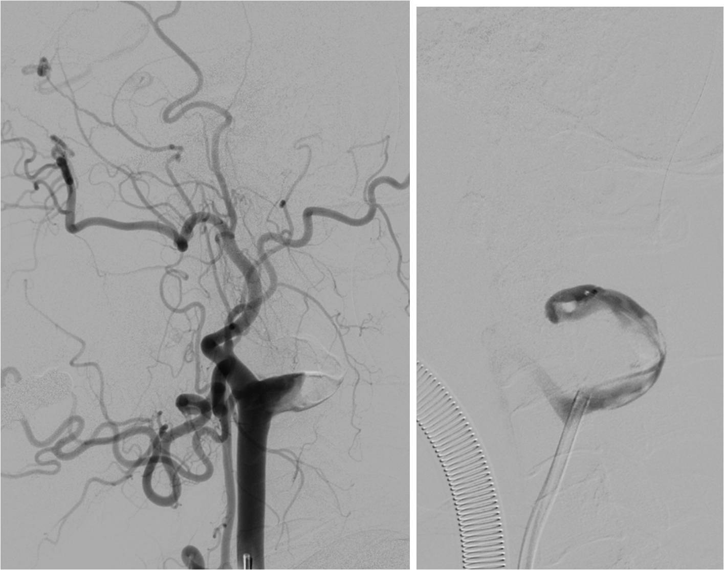 急性缺血性脑卒中血管内治疗,缺血性脑血管病的抗血小板药治疗