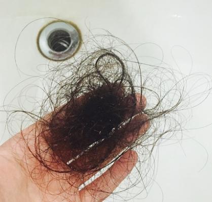 中医治疗脱发摘要,中医治疗脱发讲课