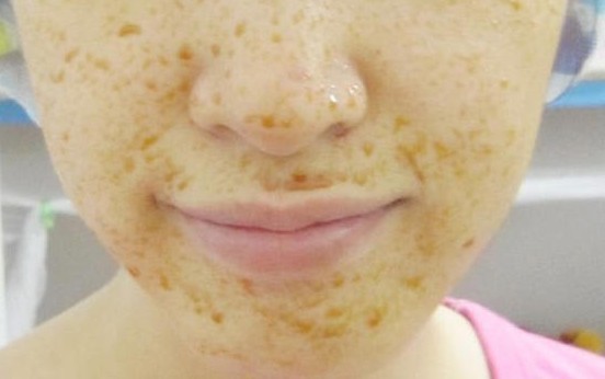 很多人不知道，五毛钱淡斑法，告别“斑女郎”肌肤雪嫩细滑如水