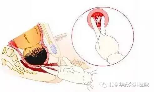 “开十指”是什么意思孕妈们误解了吗？