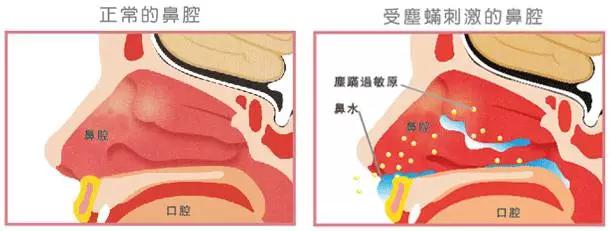 感冒和鼻炎的区别怎么治疗,宝宝感冒鼻炎的症状及表现