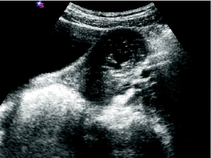 未破裂型输卵管妊娠的超声表现,宫角妊娠与输卵管间质部妊娠区别