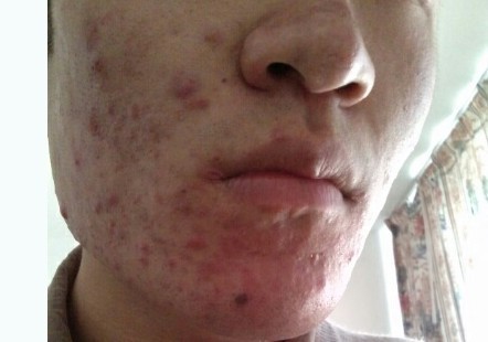 脸蛋上长痘痘的原因和解决方法,脸蛋长痘痘是什么原因怎么调理