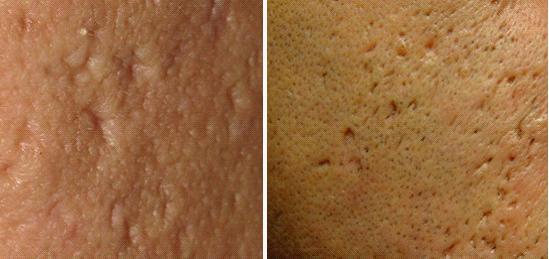 痘印难消吃什么维生素,痘印难消