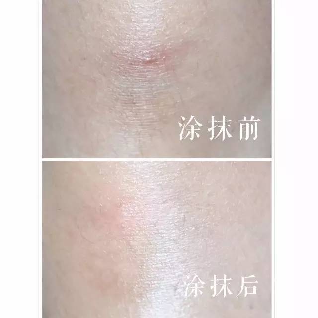 最6问答|独得蚊子专宠，怎样才能叮过无痕？