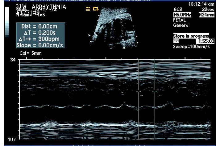 胎儿心律失常超声视频,胎儿快速型心律失常超声指标