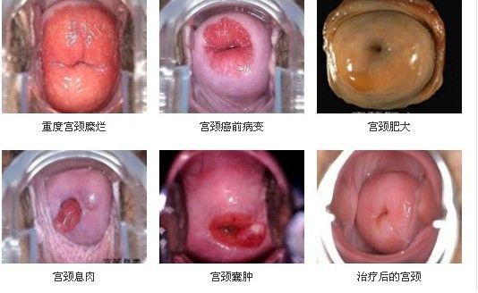 中药治疗宫颈炎的有效方法,中药治疗宫颈炎最好的方法