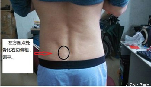 坐骨神经痛一招缓解,坐骨神经痛教你一招